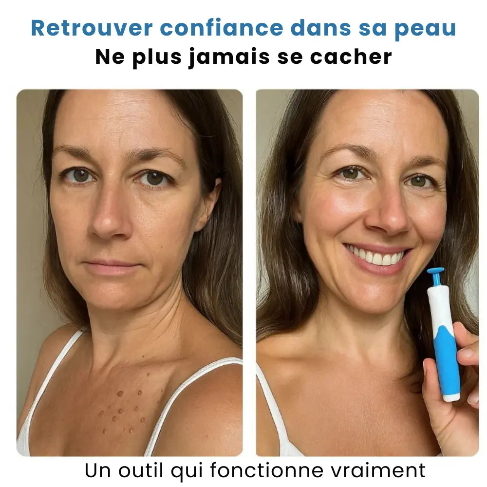 Kit Anti-Excroissances – Solution Rapide & Indolore