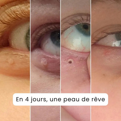 Kit Anti-Excroissances – Solution Rapide & Indolore